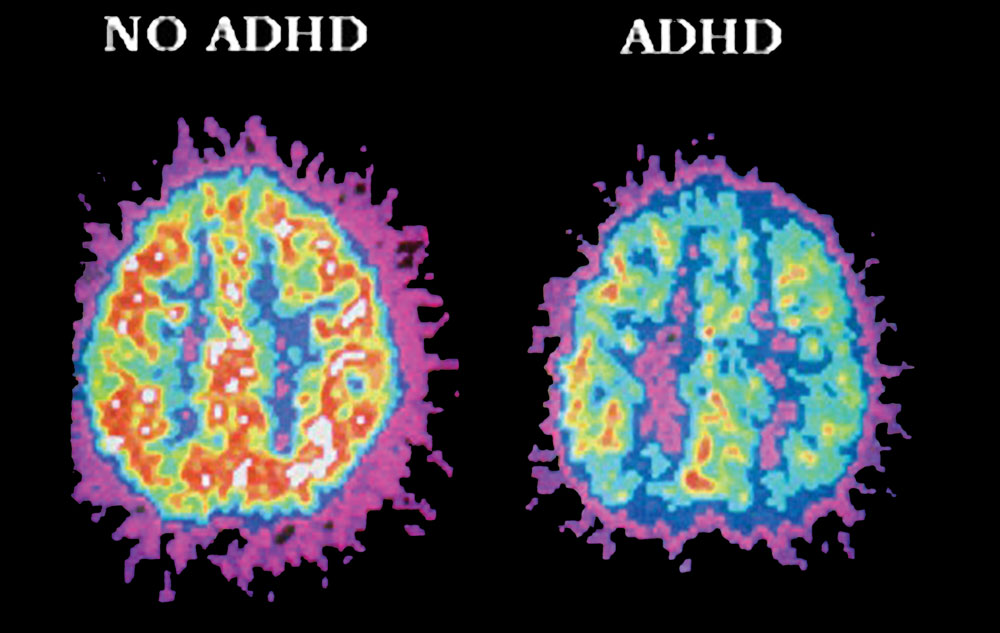 People with ADHD have less activity in areas of the brain that control attention. – edublox.com